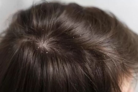 آیا استفاده از شامپوهای ضد شوره موثر است؟