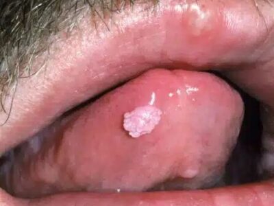 آیا زگیل تناسلی می‌تواند از طریق بزاق دهان منتقل شود؟