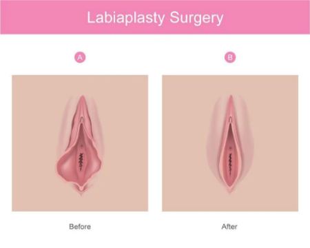 بهترین دکتر لابیاپلاستی سعادت اباد