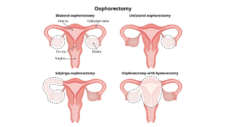 جراحی اوفورکتومی, بهبودی پس از اوفورکتومی