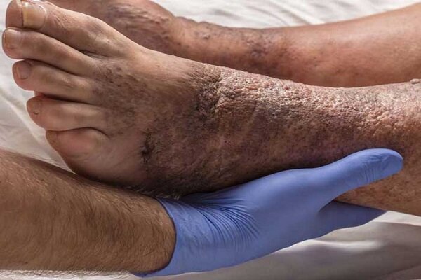 بیدردی زخم در افراد دیابتی نشانه پیشرفت آسیب عصبی است