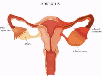 توده آدنکس رحم؛ هر آنچه باید درباره این عارضه بدانید