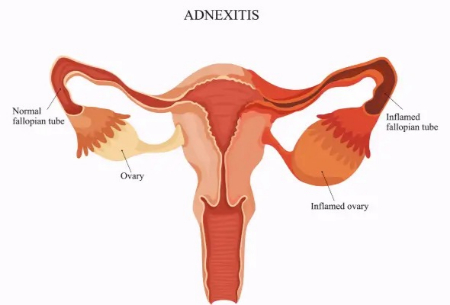 توده آدنکس رحم؛ هر آنچه باید درباره این عارضه بدانید
