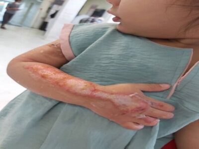 توصیه‌هایی برای پیشگیری از سوختگی