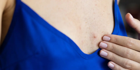 جوش سینه یا سرطان سینه؛ راهنمای جامع تشخیص