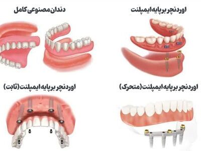 خداحافظی با لقی دندان مصنوعی؛ راهنمای جامع اوردنچر با ایمپلنت برای سالمندان