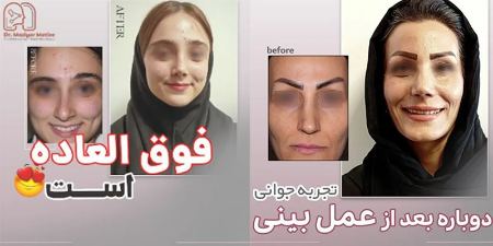 بررسی نمونه کارهای عمل بینی پزشک بررسی نمونه کارهای عمل بینی پزشک