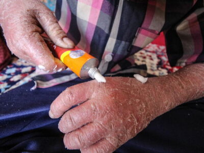 لزوم شفافیت بودجه‌ای انجمن‌های حمایت از بیماران