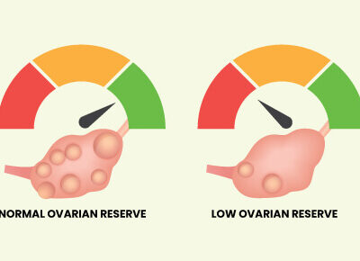 همهچیز درباره کاهش ذخیره تخمدان؛ از علائم تا راههای درمان
