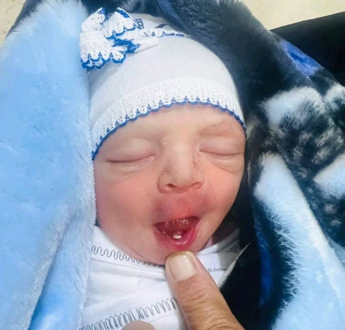 یک اتفاق نادر/ تولد یک نوزاد با دندان در بابل + تصویر یک اتفاق نادر/ تولد یک نوزاد با دندان در بابل + تصویر