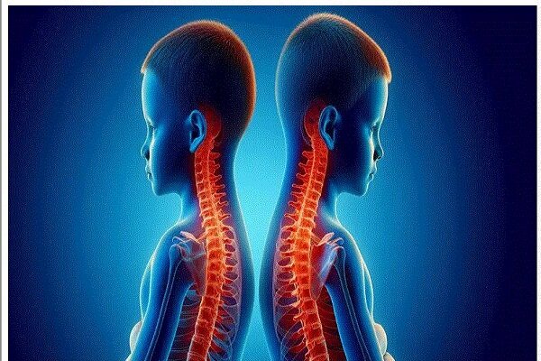 اسکولیوز تهدید خاموش ستون فقرات کودکان است؛ از هر ۲۰ نفر یک مبتلا