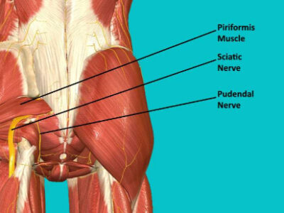 رهایی از درد مزمن کف لگن؛ داستان واقعی بهبود از نورالژی پودندال