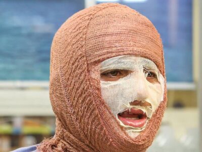 آیا بهبود کامل پس از سوختگیهای عمیق امکانپذیر است؟