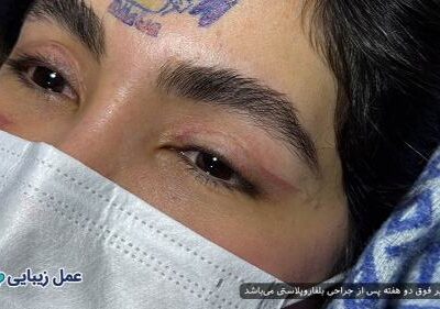 بهترین عملهای زیبایی با دوره نقاهت کوتاه برای انجام قبل از عید