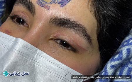 بلفاروپلاستی بلفاروپلاستی