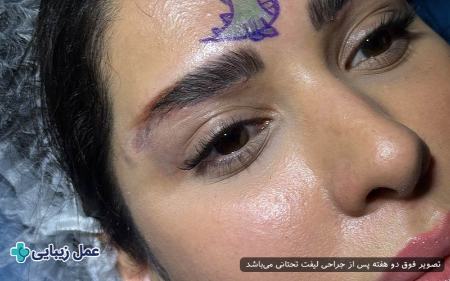 لیفت تحتانی ابرو لیفت تحتانی ابرو