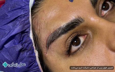 لیفت دایرکت ابرو لیفت دایرکت ابرو