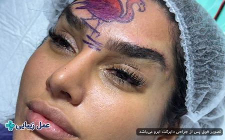 لیفت دایرکت ابرو لیفت دایرکت ابرو