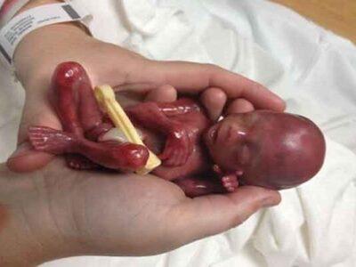 سقط جنین؛ از «صنعت پولهای سیاه» تا عوارض جبرانناپذیر جسمی و روانی