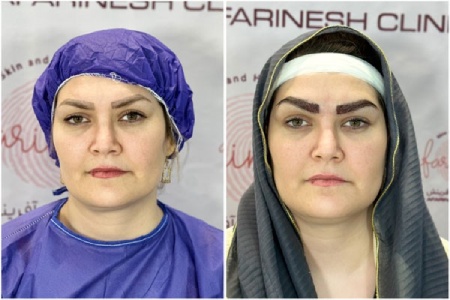 فرق میکروکاشت با کاشت ابرو چیست