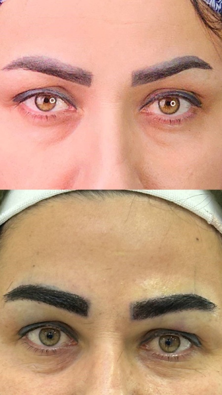 میکرو کاشت ابرو چیست؟