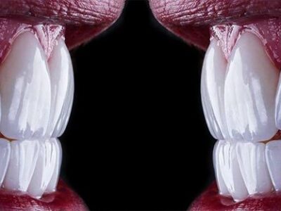 لمینت برای چه دندان هایی مناسب نیست؟ (بررسی 6 مورد ممنوعه + جایگزینها)