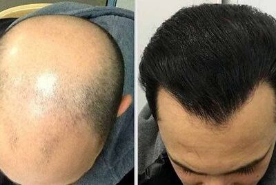 هزینه کاشت مو در تهران + قیمت انواع روش های کاشت مو در بهترین کلینیک تهران