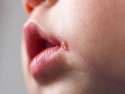 تفاوت آفت و تبخال در کودکان