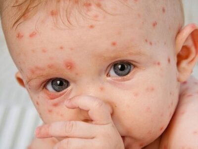 شیوع «آبله مرغان» در بهار