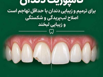 ایمپلنت، کامپوزیت یا لمینت، هر کدام برای چه مشکلی مناسب هستند؟
