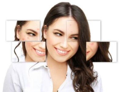 بهترین کلینیک زیبایی تهران برای لیزر لک صورت