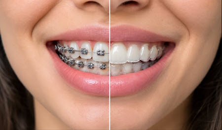 تفاوت های ارتودنسی ثابت و متحرک