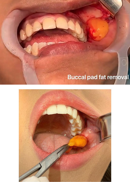 تأثیر جراحی بوکال فت, تخلیه چربی صورت, جراحی تخلیه چربی صورت